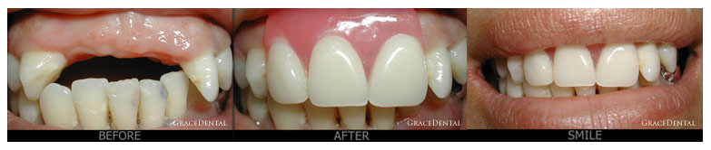 Dentures