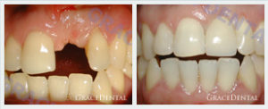 Implant Cases