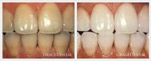 Whitening